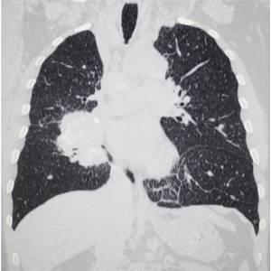 lung cancer xray